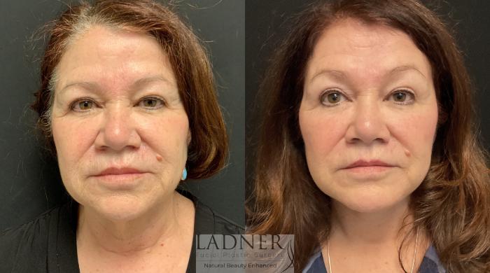 Before: Necklift with Liposuction & Platysmaplasty