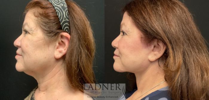 Before: Neck Lift with Liposuction & Platysmaplasty