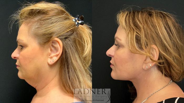 Facelift / Neck Lift Case 149 Before & After Left Side | Denver, CO | Ladner Facial Plastic Surgery
