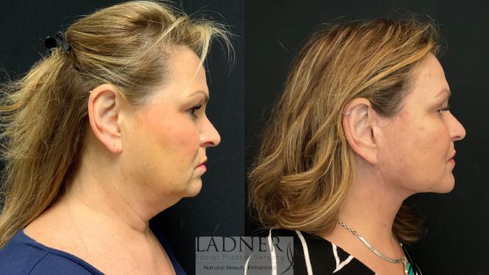 Facelift / Neck Lift Case 149 Before & After Right Side | Denver, CO | Ladner Facial Plastic Surgery