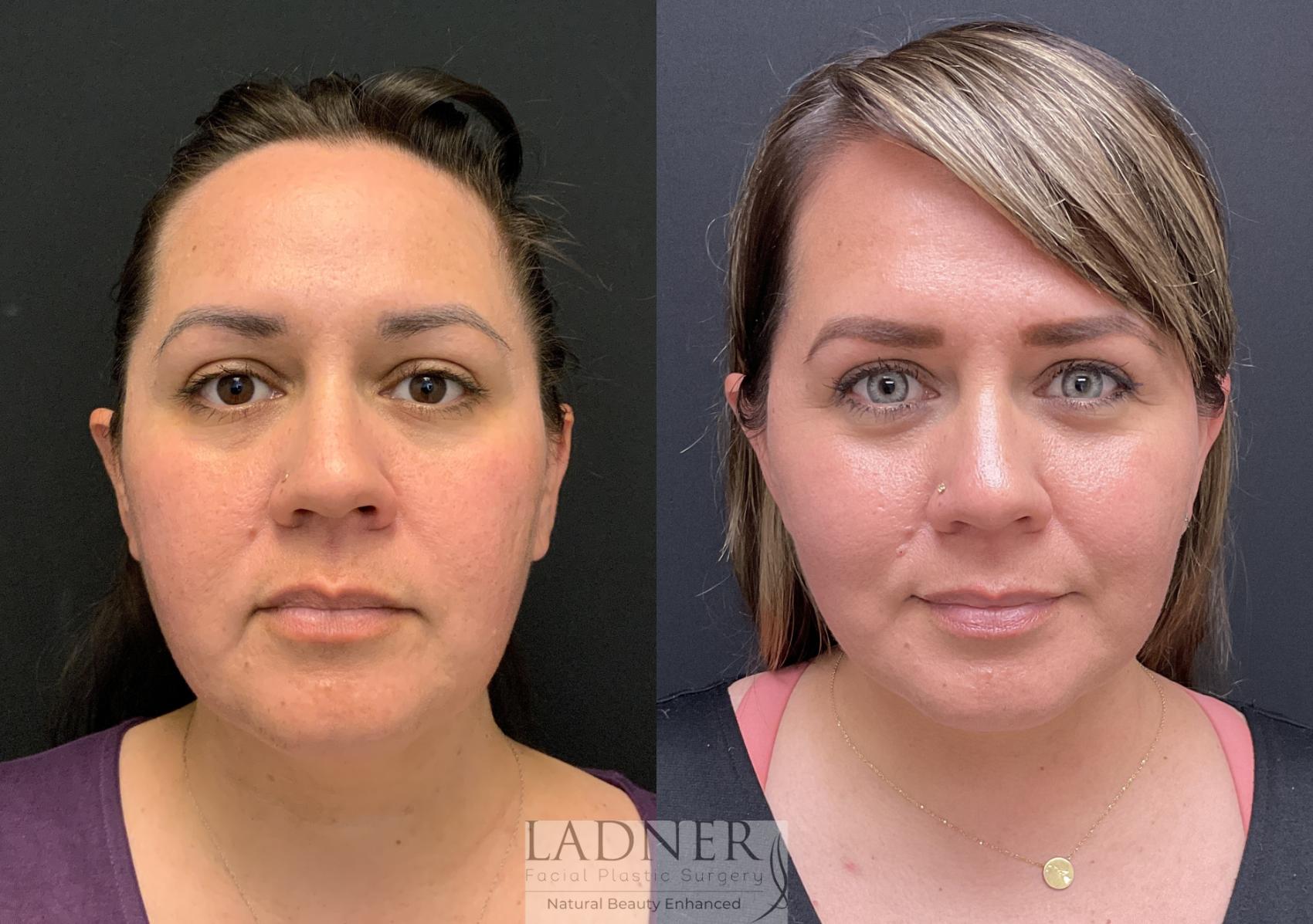 Facelift / Neck Lift Case 152 Before & After Front | Denver, CO | Ladner Facial Plastic Surgery