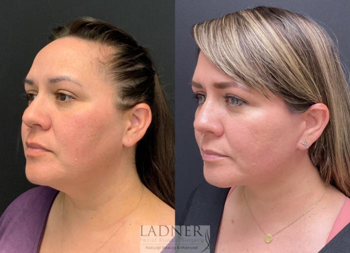 Facelift / Neck Lift Case 152 Before & After Left Oblique | Denver, CO | Ladner Facial Plastic Surgery