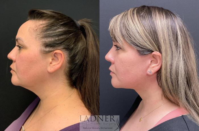 Facelift / Neck Lift Case 152 Before & After Left Side | Denver, CO | Ladner Facial Plastic Surgery