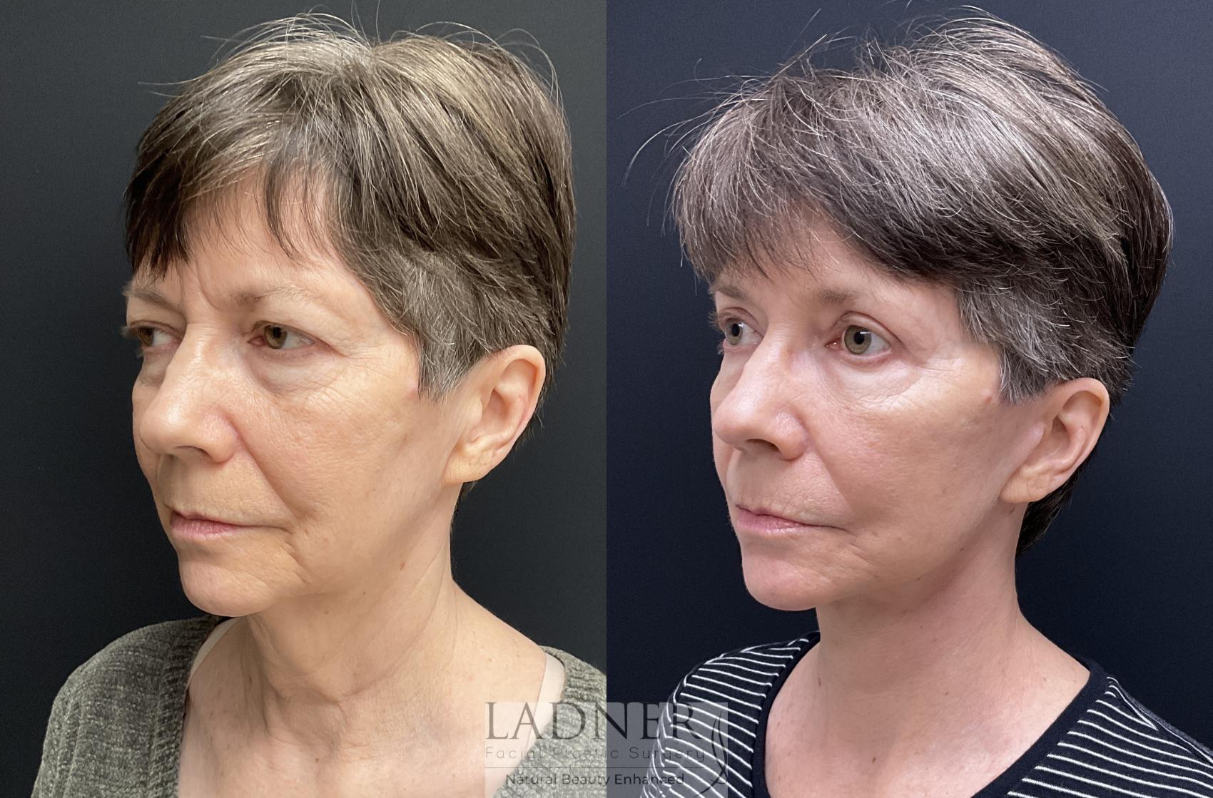 Brow Lift / Forehead Lift Case 157 Before & After Left Oblique | Denver, CO | Ladner Facial Plastic Surgery