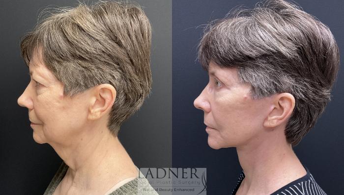 Facelift / Neck Lift Case 157 Before & After Left Side | Denver, CO | Ladner Facial Plastic Surgery