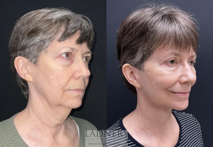 Facelift / Neck Lift Case 157 Before & After Right Oblique | Denver, CO | Ladner Facial Plastic Surgery