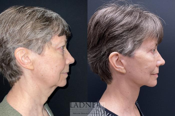 Facial Fat Transfer Case 157 Before & After Right Side | Denver, CO | Ladner Facial Plastic Surgery