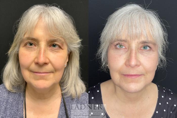 Facial Fat Transfer Case 163 Before & After Front | Denver, CO | Ladner Facial Plastic Surgery
