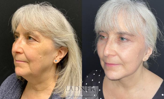 Facelift / Neck Lift Case 163 Before & After Left Oblique | Denver, CO | Ladner Facial Plastic Surgery