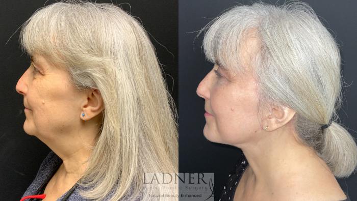 Facial Fat Transfer Case 163 Before & After Left Side | Denver, CO | Ladner Facial Plastic Surgery