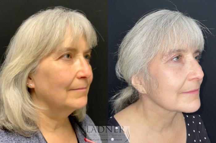 Facial Fat Transfer Case 163 Before & After Right Oblique | Denver, CO | Ladner Facial Plastic Surgery