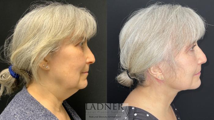 Facelift / Neck Lift Case 163 Before & After Right Side | Denver, CO | Ladner Facial Plastic Surgery