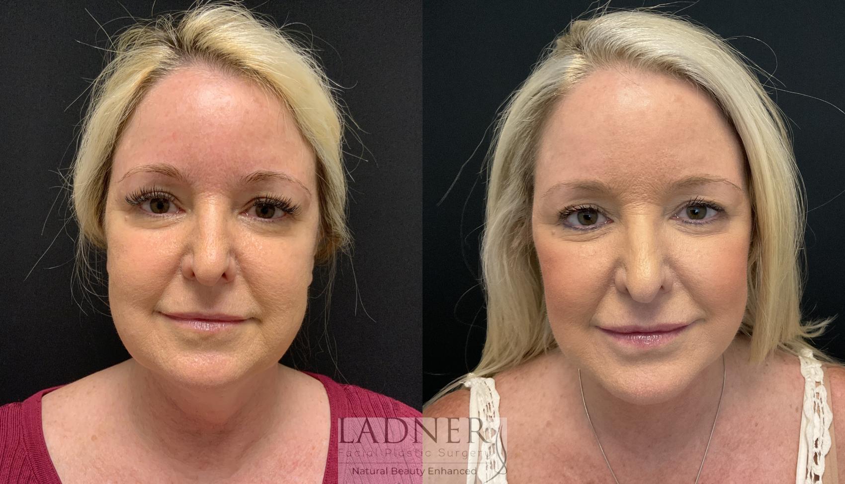 Facelift / Neck Lift Case 164 Before & After Front | Denver, CO | Ladner Facial Plastic Surgery