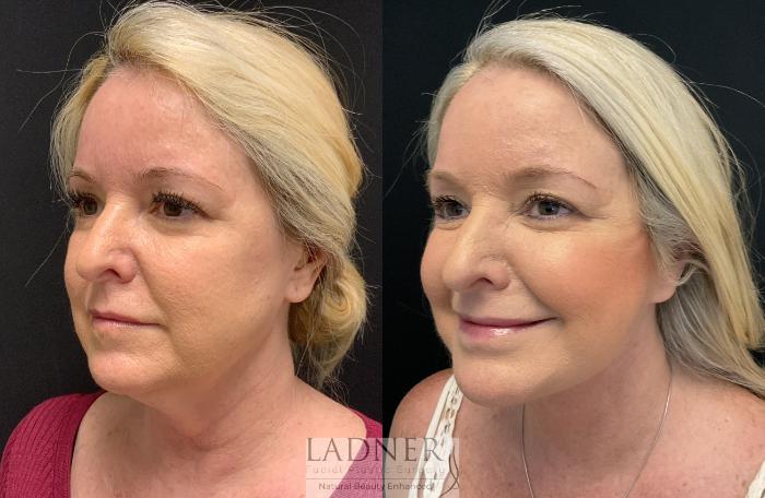 Facelift / Neck Lift Case 164 Before & After Left Oblique | Denver, CO | Ladner Facial Plastic Surgery