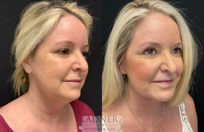 Facelift / Neck Lift Case 164 Before & After Right Oblique | Denver, CO | Ladner Facial Plastic Surgery