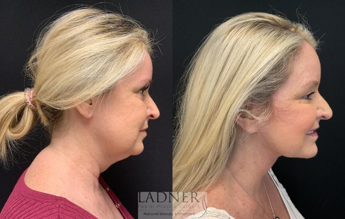 Facelift / Neck Lift Case 164 Before & After Right Side | Denver, CO | Ladner Facial Plastic Surgery
