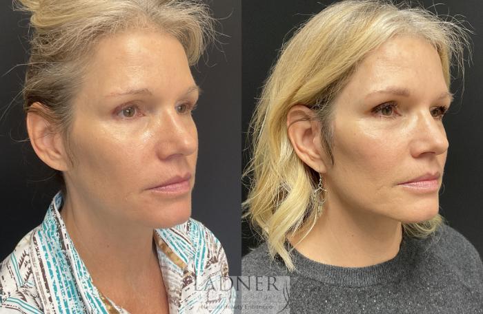 Facelift / Neck Lift Case 165 Before & After Right Oblique | Denver, CO | Ladner Facial Plastic Surgery
