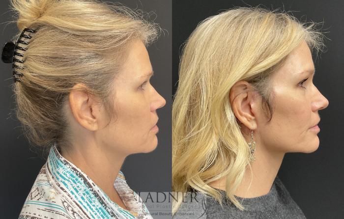 Facelift / Neck Lift Case 165 Before & After Right Side | Denver, CO | Ladner Facial Plastic Surgery