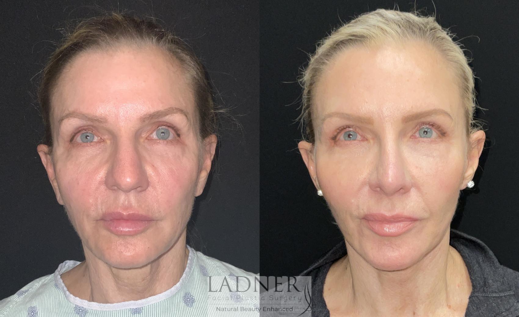 Facelift / Neck Lift Case 167 Before & After Front | Denver, CO | Ladner Facial Plastic Surgery