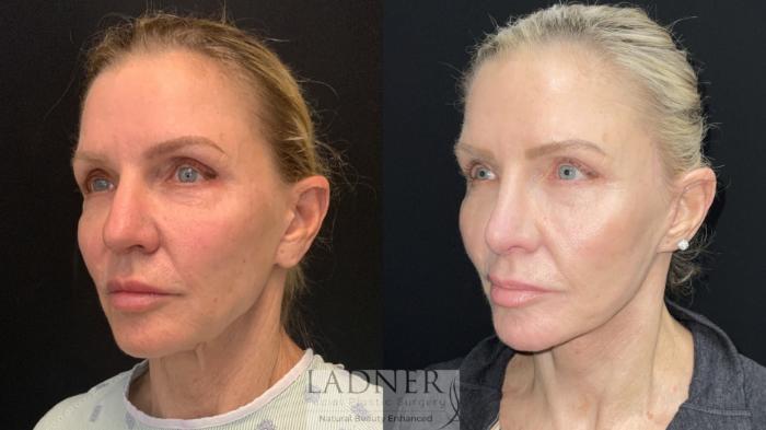 Facial Fat Transfer Case 167 Before & After Left Oblique | Denver, CO | Ladner Facial Plastic Surgery