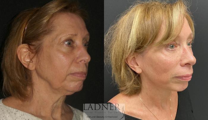 Facelift / Neck Lift Case 170 Before & After Right Oblique | Denver, CO | Ladner Facial Plastic Surgery