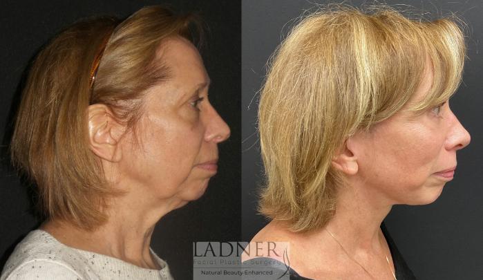 Brow Lift / Forehead Lift Case 170 Before & After Right Side | Denver, CO | Ladner Facial Plastic Surgery