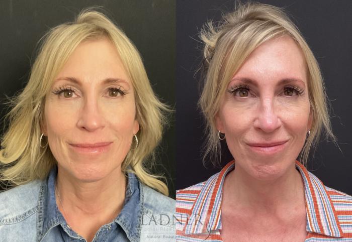 Facelift / Neck Lift Case 206 Before & After Front | Denver, CO | Ladner Facial Plastic Surgery