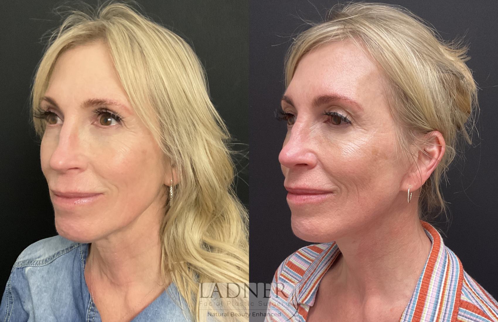 Facelift / Neck Lift Case 206 Before & After Left Oblique | Denver, CO | Ladner Facial Plastic Surgery