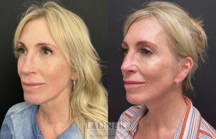 Facelift / Neck Lift Case 206 Before & After Left Oblique | Denver, CO | Ladner Facial Plastic Surgery