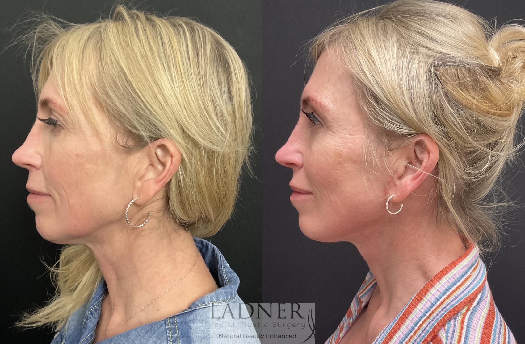 Facelift / Neck Lift Case 206 Before & After Left Side | Denver, CO | Ladner Facial Plastic Surgery