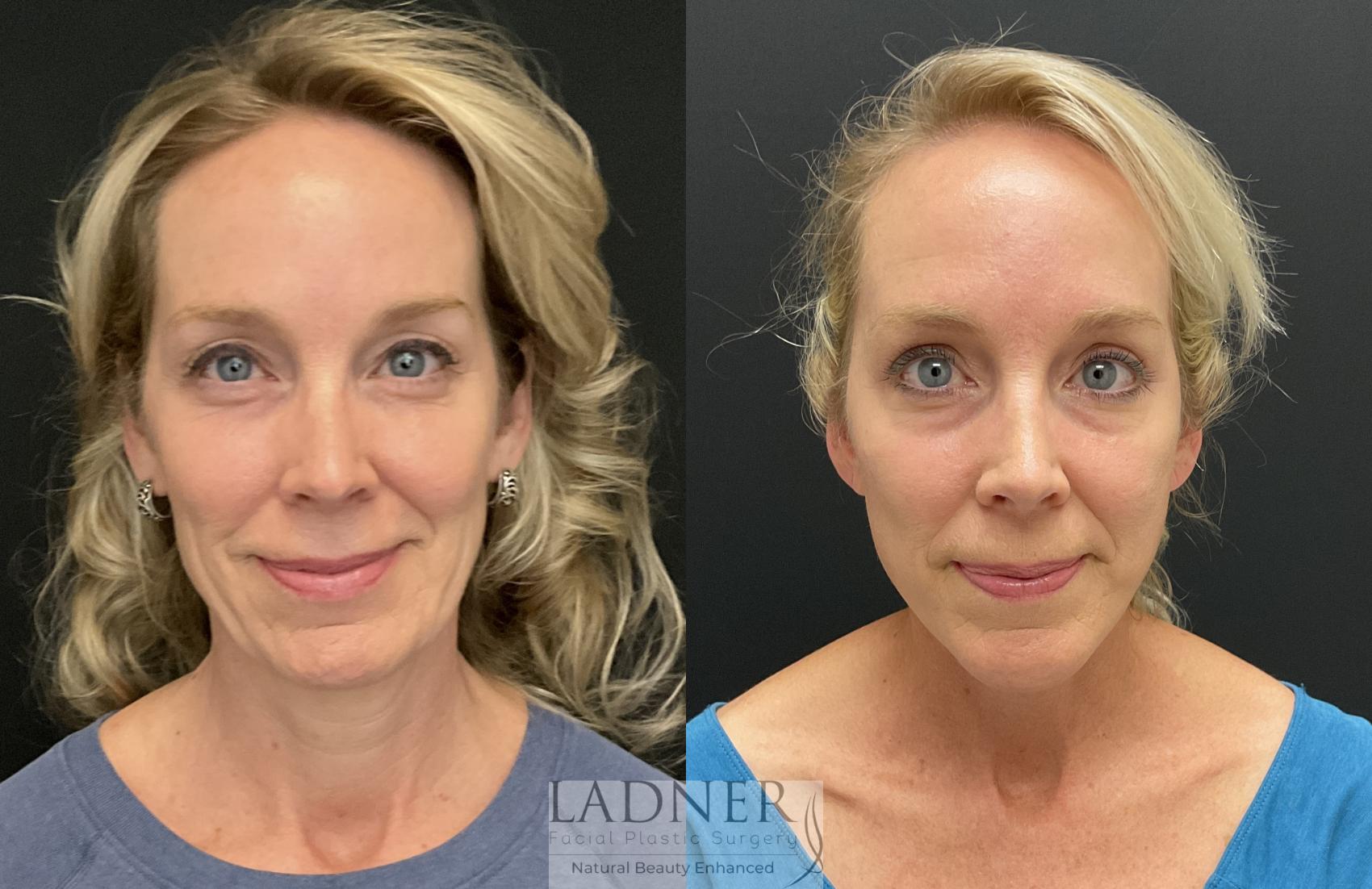 Eyelid Surgery (blepharoplasty) Case 223 Before & After Front | Denver, CO | Ladner Facial Plastic Surgery
