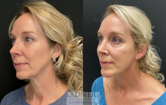 Facelift / Neck Lift Case 223 Before & After Left Oblique | Denver, CO | Ladner Facial Plastic Surgery