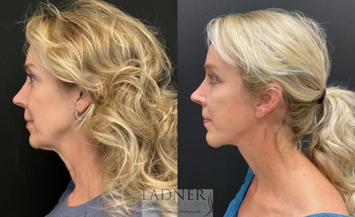 Facelift / Neck Lift Case 223 Before & After Left Side | Denver, CO | Ladner Facial Plastic Surgery