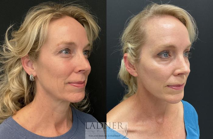 Facelift / Neck Lift Case 223 Before & After Right Oblique | Denver, CO | Ladner Facial Plastic Surgery