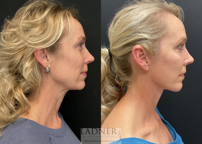 Facelift / Neck Lift Case 223 Before & After Right Side | Denver, CO | Ladner Facial Plastic Surgery
