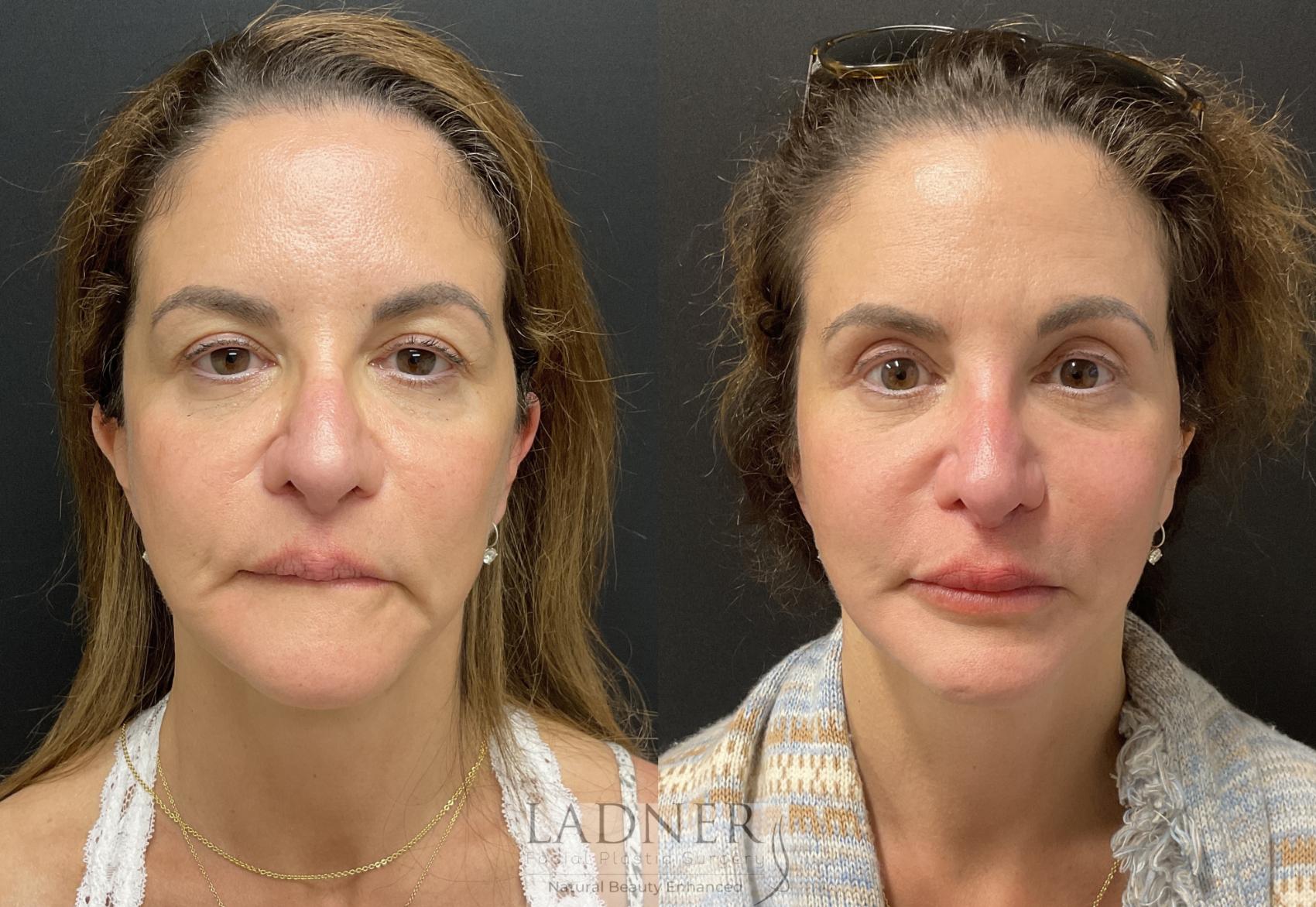 Facelift / Neck Lift Case 232 Before & After Front | Denver, CO | Ladner Facial Plastic Surgery