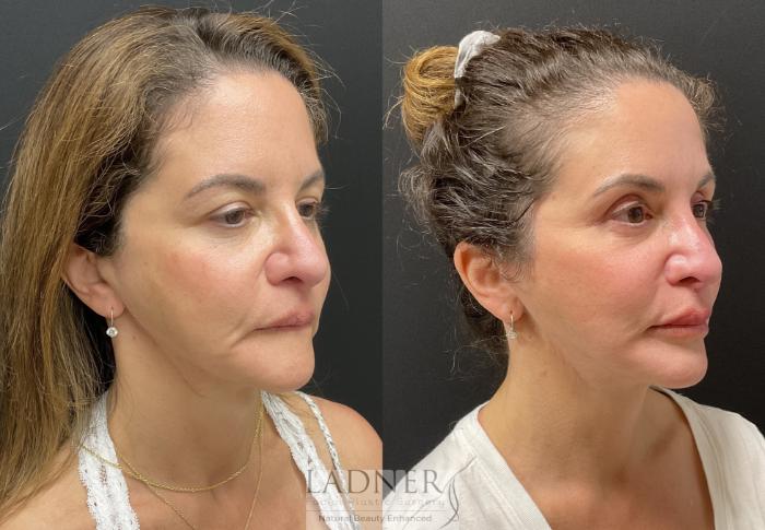 Facial Fat Transfer Case 232 Before & After Right Oblique | Denver, CO | Ladner Facial Plastic Surgery