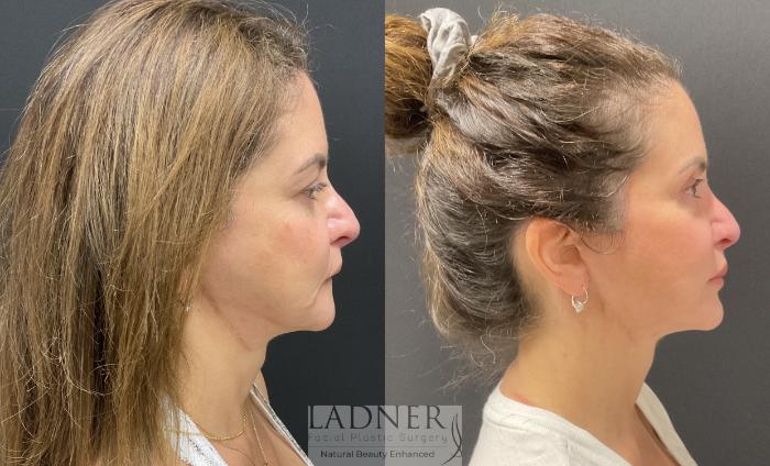 Facelift / Neck Lift Case 232 Before & After Right Side | Denver, CO | Ladner Facial Plastic Surgery