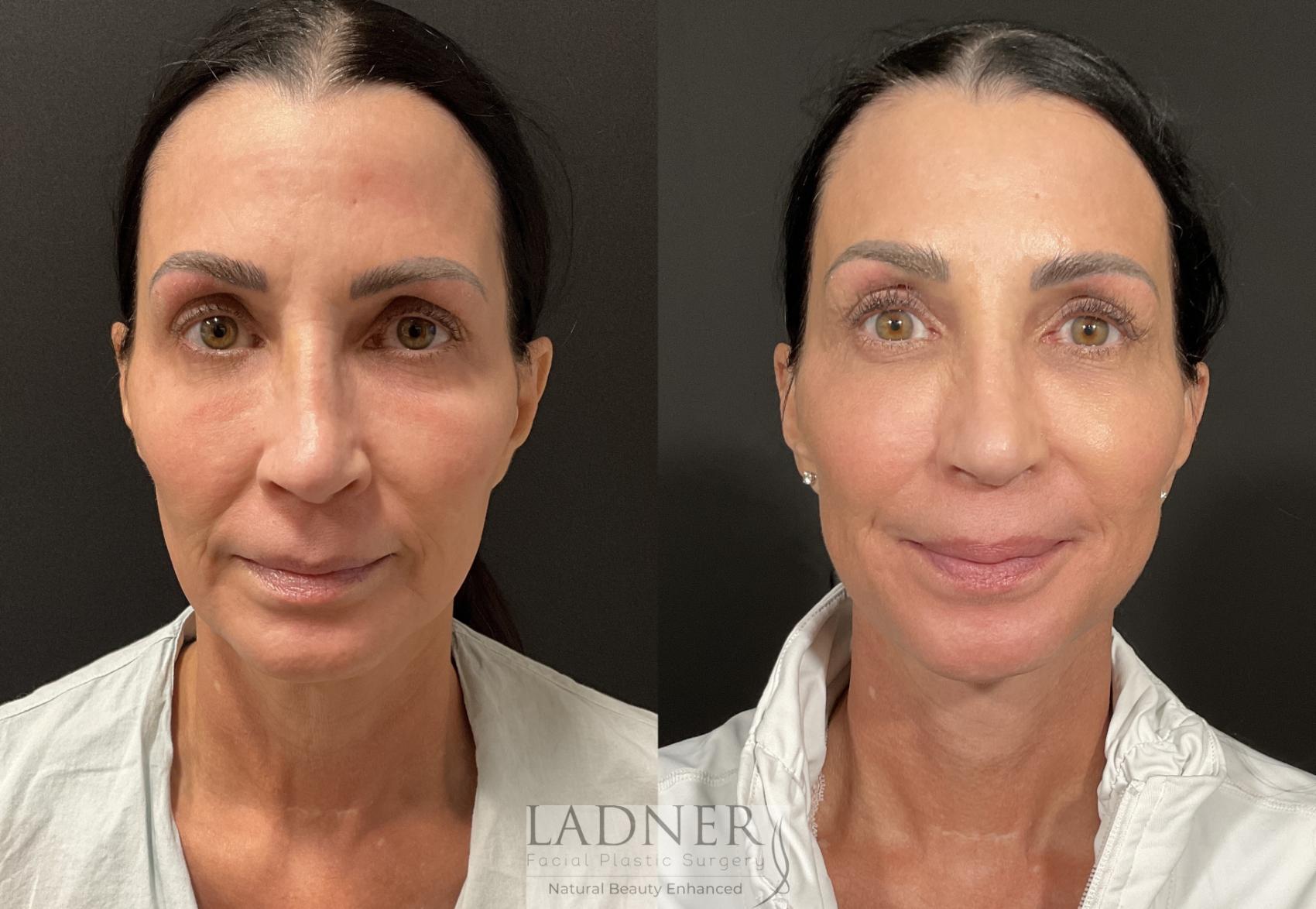 Facial Fat Transfer Case 241 Before & After Front | Denver, CO | Ladner Facial Plastic Surgery