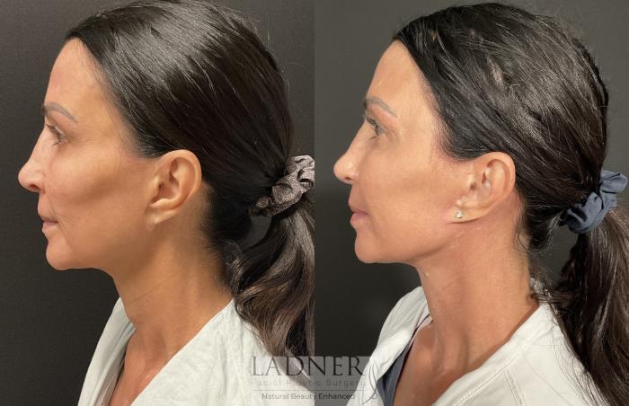Facial Fat Transfer Case 241 Before & After Left Side | Denver, CO | Ladner Facial Plastic Surgery