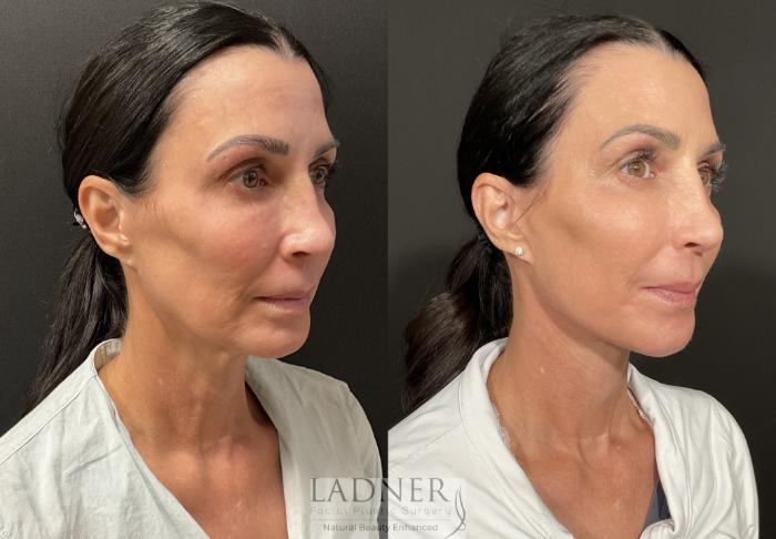 Facial Fat Transfer Case 241 Before & After Right Oblique | Denver, CO | Ladner Facial Plastic Surgery