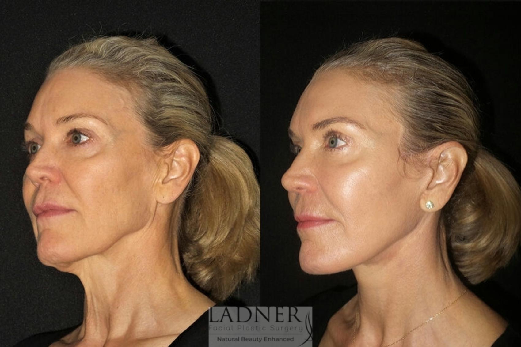 Facelift / Neck Lift Case 26 Before & After Left Oblique | Denver, CO | Ladner Facial Plastic Surgery