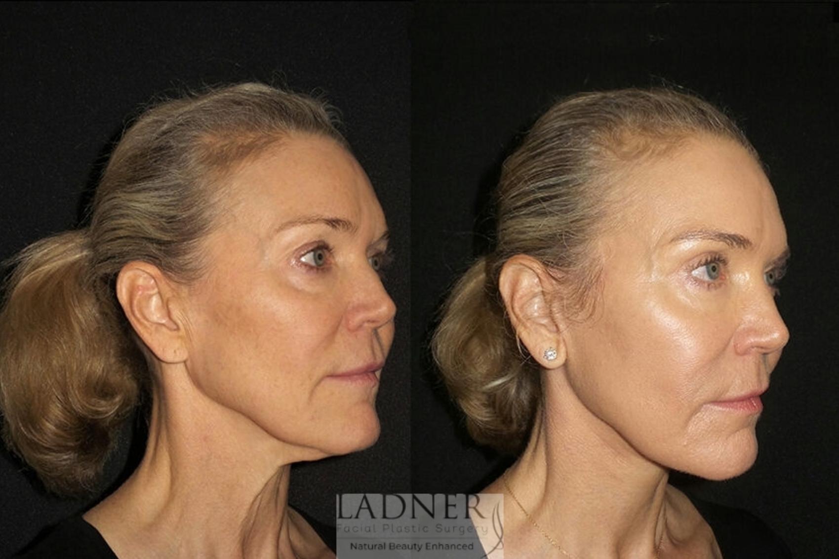 Facelift / Neck Lift Case 26 Before & After Right Oblique | Denver, CO | Ladner Facial Plastic Surgery