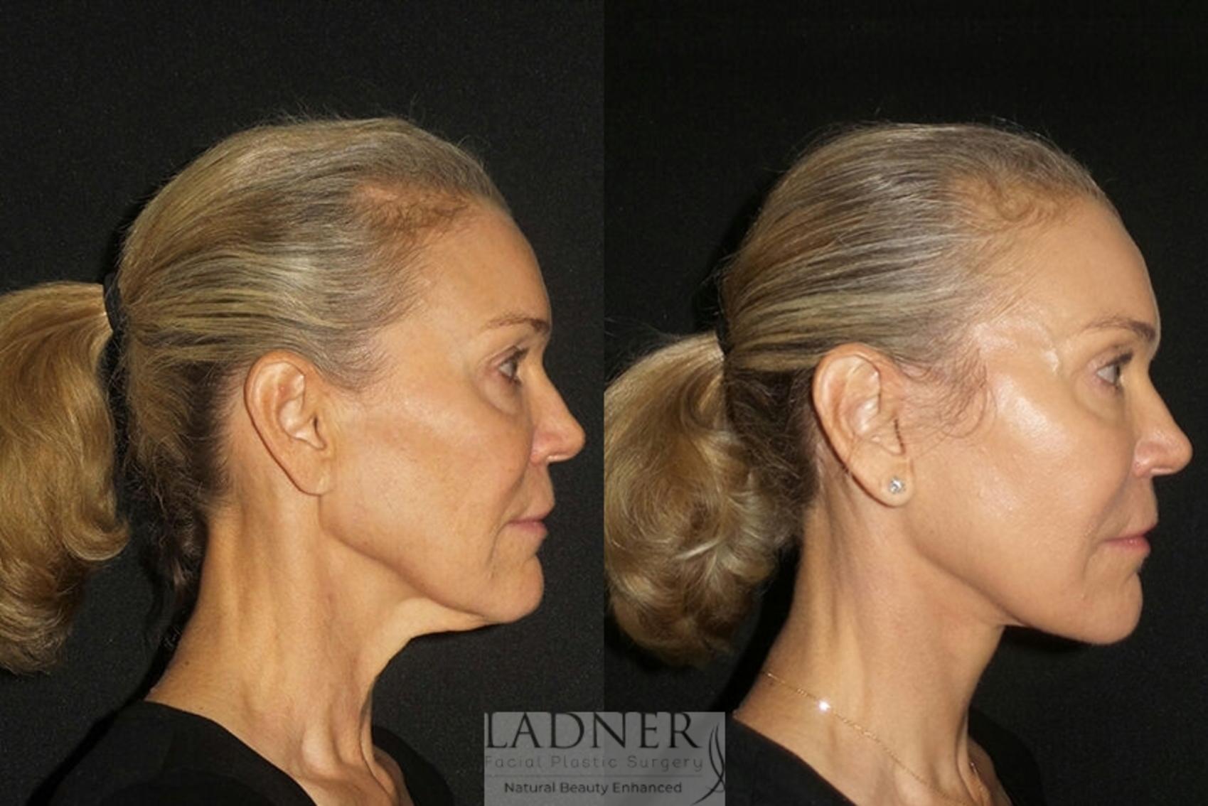 Facial Rejuvenation Case 26 Before & After Right Side | Denver, CO | Ladner Facial Plastic Surgery