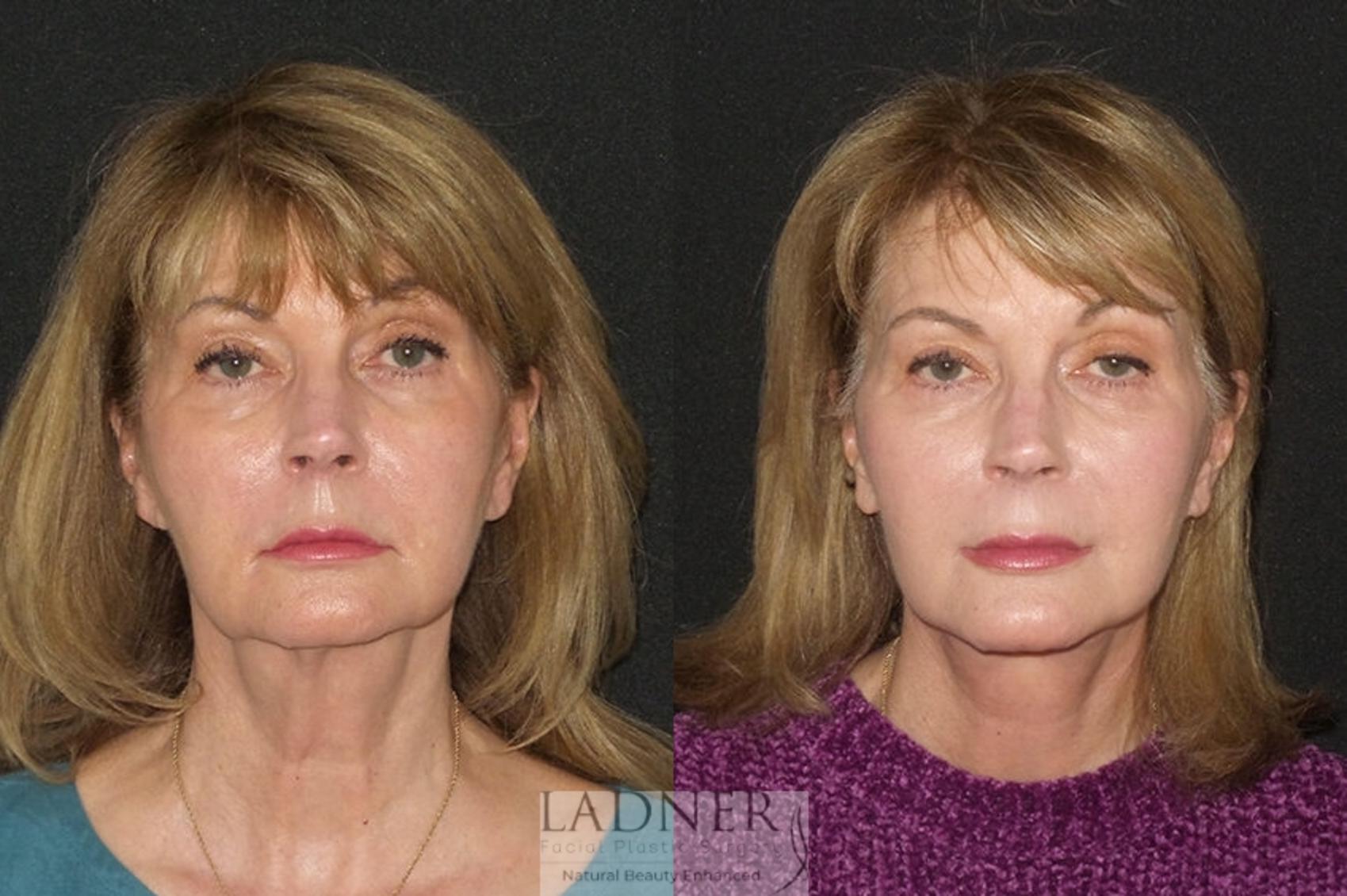 Facelift / Neck Lift Case 27 Before & After Front | Denver, CO | Ladner Facial Plastic Surgery