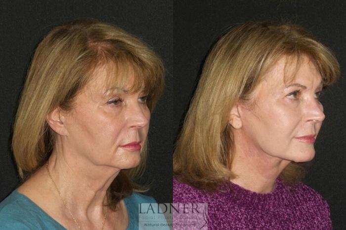 Facelift / Neck Lift Case 27 Before & After Right Oblique | Denver, CO | Ladner Facial Plastic Surgery