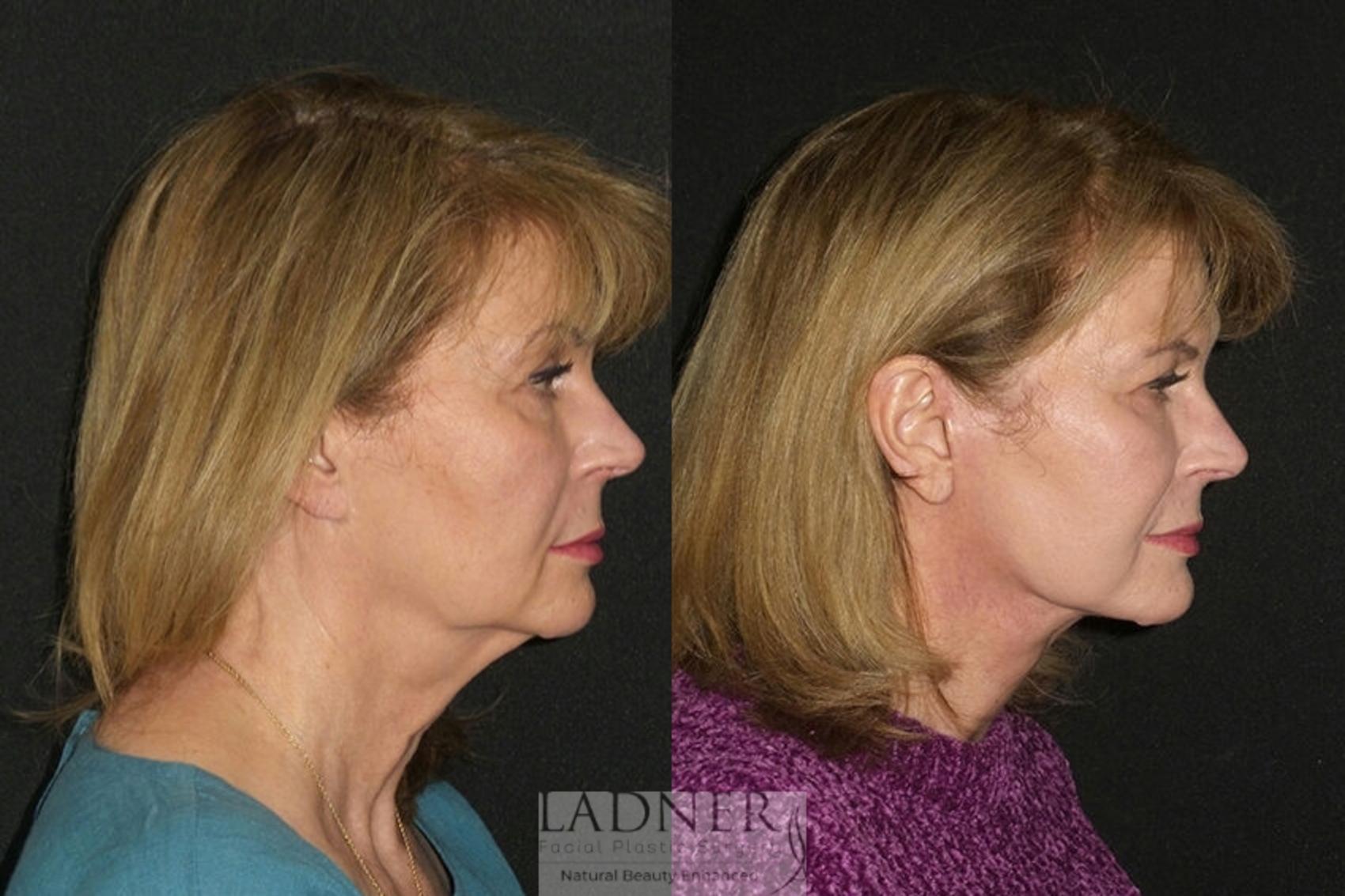 Facelift / Neck Lift Case 27 Before & After Right Side | Denver, CO | Ladner Facial Plastic Surgery