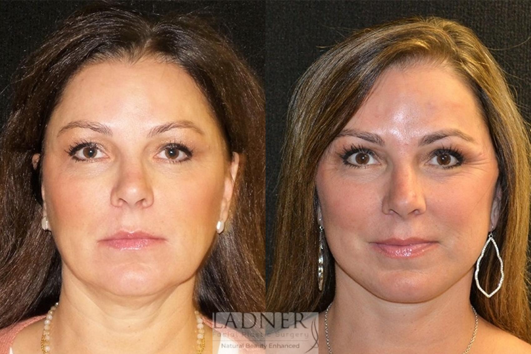 Facelift / Neck Lift Case 29 Before & After Front | Denver, CO | Ladner Facial Plastic Surgery