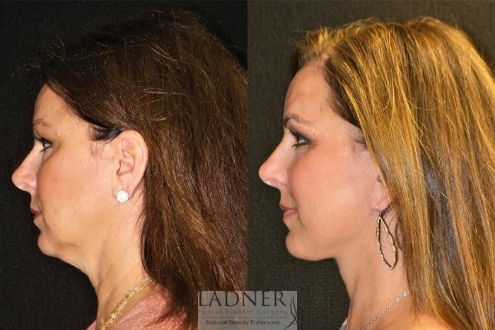 Facelift / Neck Lift Case 29 Before & After Left Side | Denver, CO | Ladner Facial Plastic Surgery