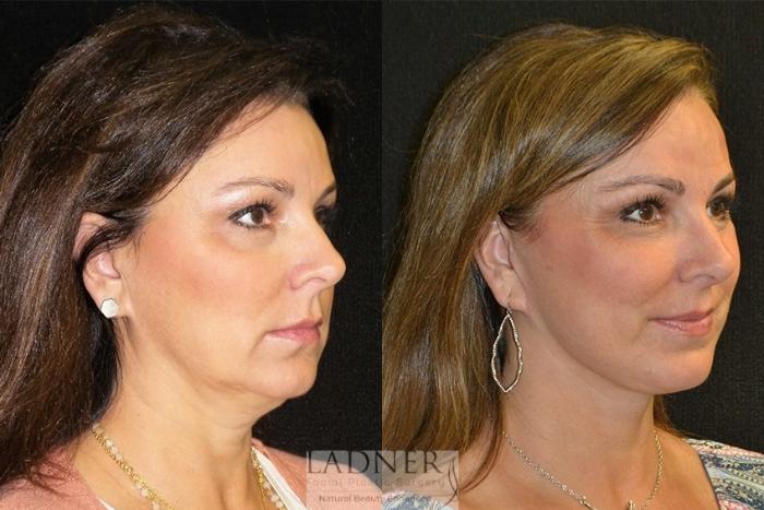 Facelift / Neck Lift Case 29 Before & After Right Oblique | Denver, CO | Ladner Facial Plastic Surgery